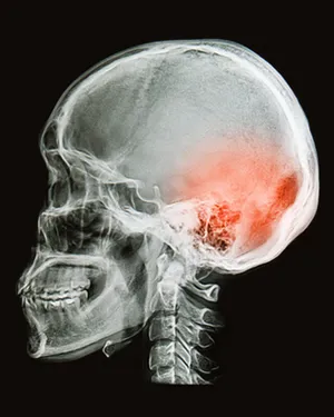 original_brain-injury5057-2